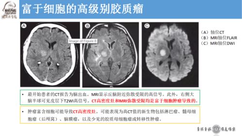 百度蜘蛛池租用:颅后池增大与蜘蛛网膜病变，临床诊断与治疗探讨